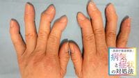 ｢手指の痛み･こわばり･変形｣リウマチとどう違う