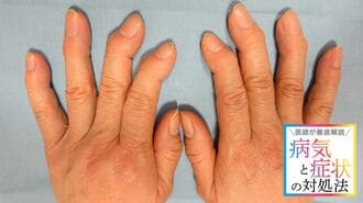 ｢手指の痛み･こわばり･変形｣リウマチとどう違う