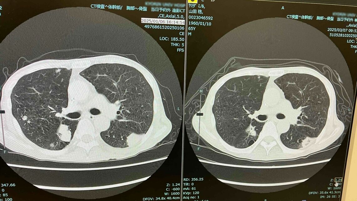 肺の腫瘍は明らかに小さくなった（左が1月／右が3月）